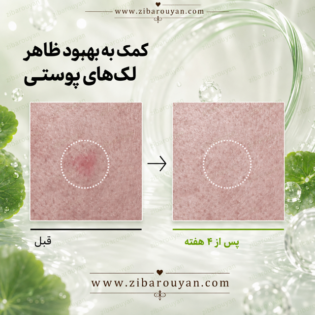 تونر آزلائیک اسید 3% و سیکا آنوا
