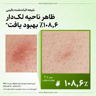 سرم تسکین دهنده قرمزی آزلائیک اسید 10% و هیالورون آنوا