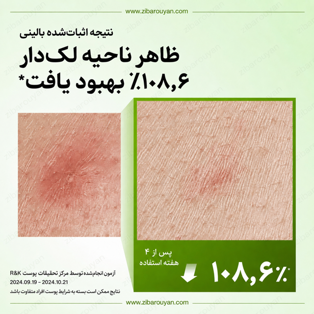 سرم تسکین دهنده قرمزی آزلائیک اسید 10% و هیالورون آنوا